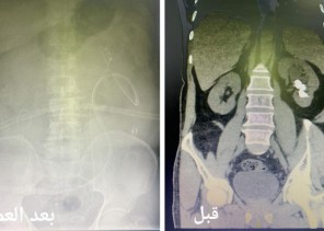 أكثر من ساعتين لإزالة حصوات كلوية لمريض بجدة