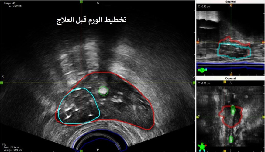 فريق طبي يتمكن من علاج ورم في غدة البروستات.. ورئيس الفريق الدكتور “سعد الرشيدي”: المريض تلقى 39 جلسة من العلاج الإشعاعي الخارجي